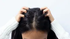 Saçtaki Kepek Sorununa Doğal ve Kesin Çözüm: Uzmanların Önerdiği O Sirke Karışımı!